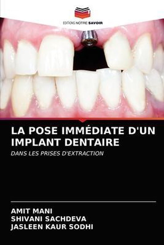 La Pose Immediate d'Un Implant Dentaire