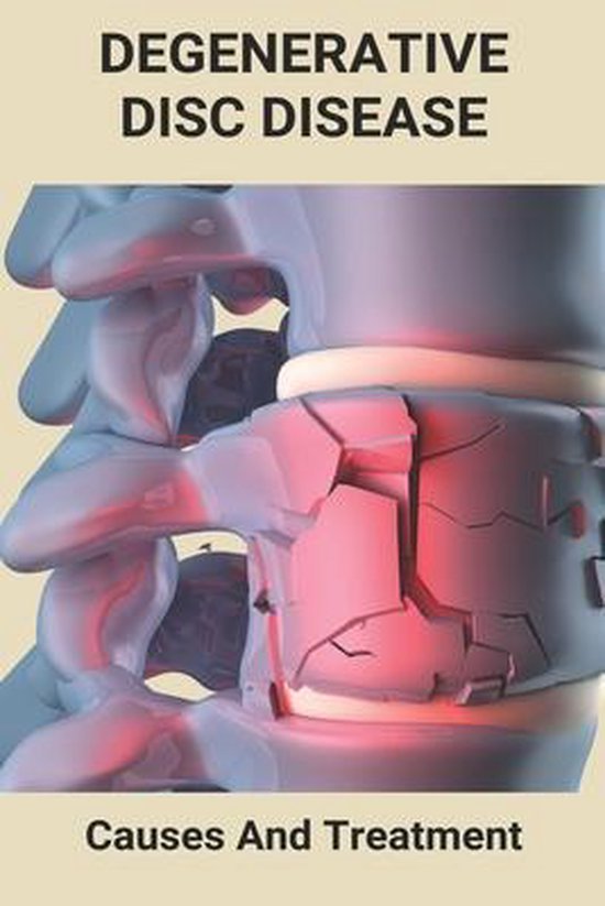 Degenerative Disc Disease Causes And Treatment, Calvin Killoy