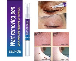 Wrattenbehandeling | Waterwratjes stick - 15 ml - Wrattenstick | Vloeibare Pen Behandeling | Papillomas Verwijderen