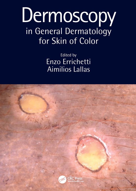 Dermoscopy in General Dermatology for Skin of Color - cover
