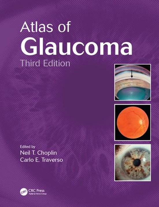Atlas of Glaucoma - cover