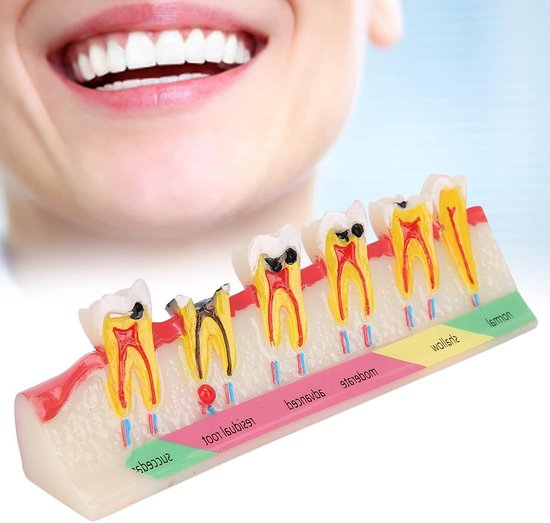 Tandbederf Model - Tand Anatomie - Onderwijs & Demonstratie - Gedetailleerde Structuren - 15 x 4 x 4 cm - Kleurrijk — afbeelding 3