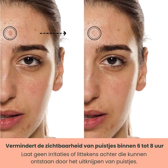 Vergelijking van een voorhoofd met acne, met en zonder puistjespatch, binnen 6 tot 8 uur.