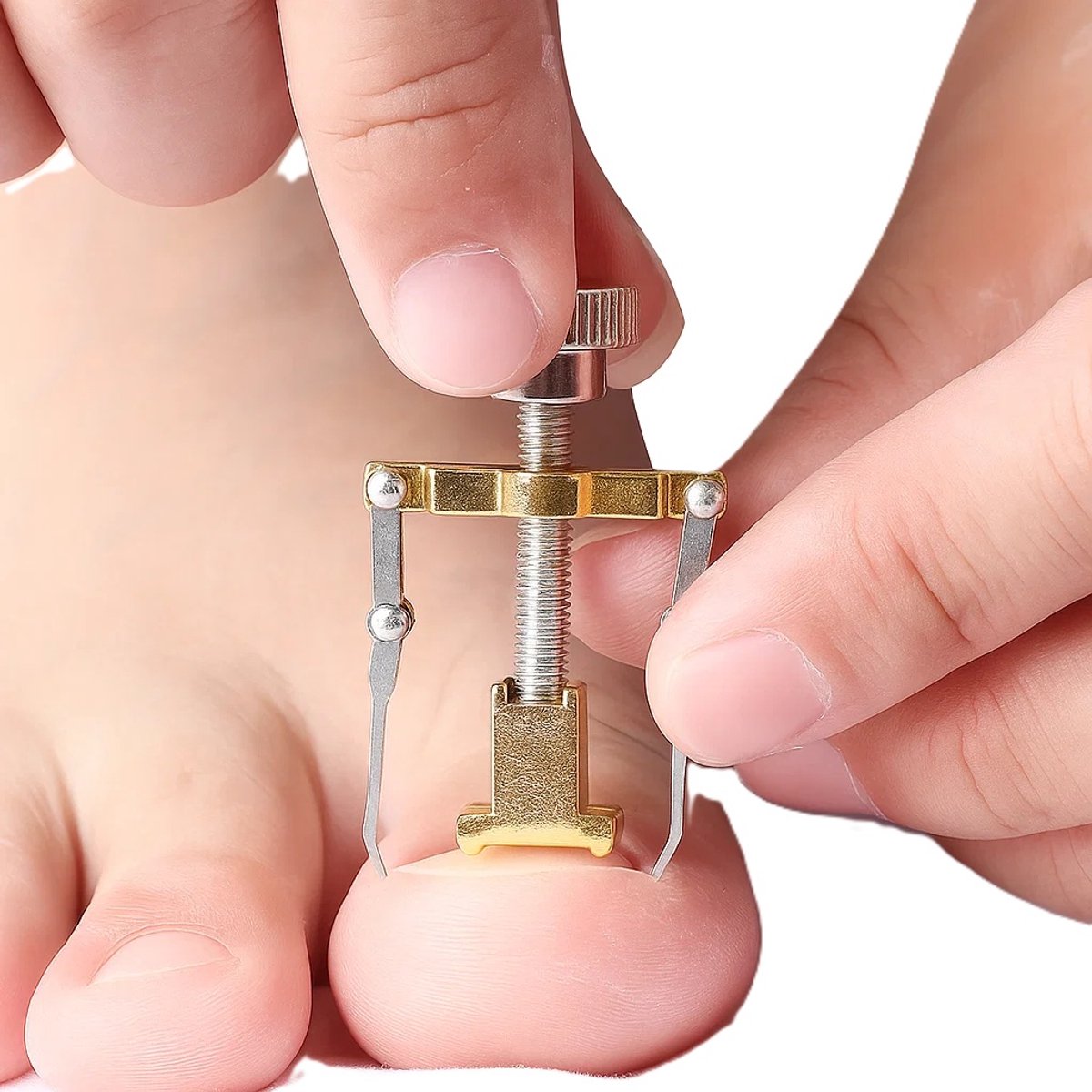 Ingegroeide Teennagel Lifter I Teennagel Corrector I teennagel Lift I Teennagels Correctie