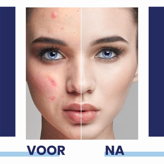 Voor en na foto van een gezicht, met huidproblemen links en gave huid rechts.