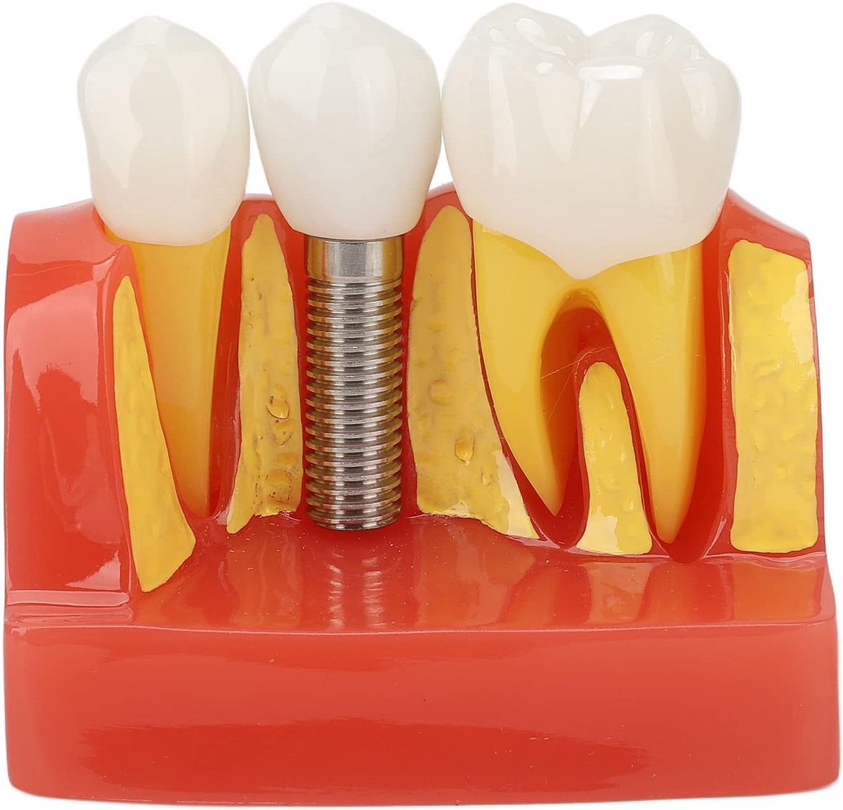 SnelShoppen - Dental Implant Model voor Tandartsen, Analyse Crown Bridge Model, Verwijderbare Tandheelkundige Demonstratie, Onderwijsmodel voor Tandhe