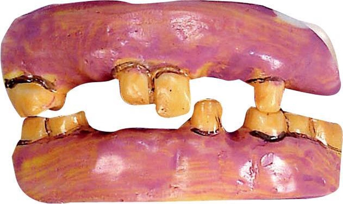 Prothèses - Facettes - Dents Witte - Dents Artificielles