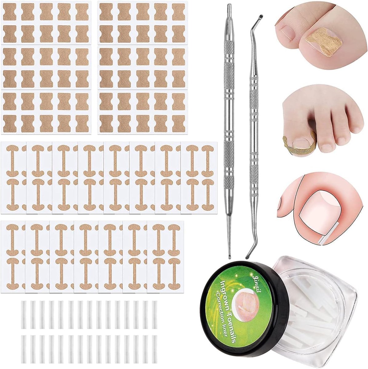 SnelShoppen - Pedicure Set 152 Stukken Voor Ingroeiende Teennagels - Inclusief Elastische Patches, Gebogen Teennagelklemmen, Correctiestickers, Vijl &