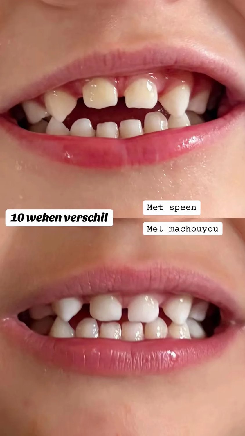 Machouyou® Original - Oranje - Mondhulpstuk voor Kinderen - Speenafbouw - Zuiggewoonte - Medisch Siliconen - 2 tm 6 jaar — afbeelding 3