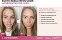 Twee afbeeldingen van Marieke: links 'voor' met acné, rechts 'na' met een rustigere, gezondere huid.