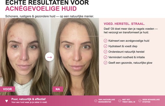 Twee afbeeldingen van Marieke: links 'voor' met acné, rechts 'na' met een rustigere, gezondere huid.