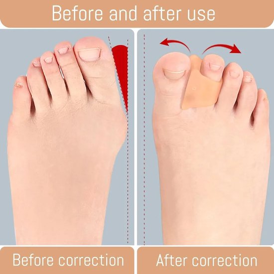 12-delige set voor de correctie van hamerteen, teenscheider, teencorrector, gel teenspalk, ter verlichting van hallux valgus, hamerteen, gebogen teen, klauwteen. van SKIEHAN — afbeelding 2