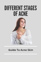 Different Stages Of Acne: Guide To Acne Skin