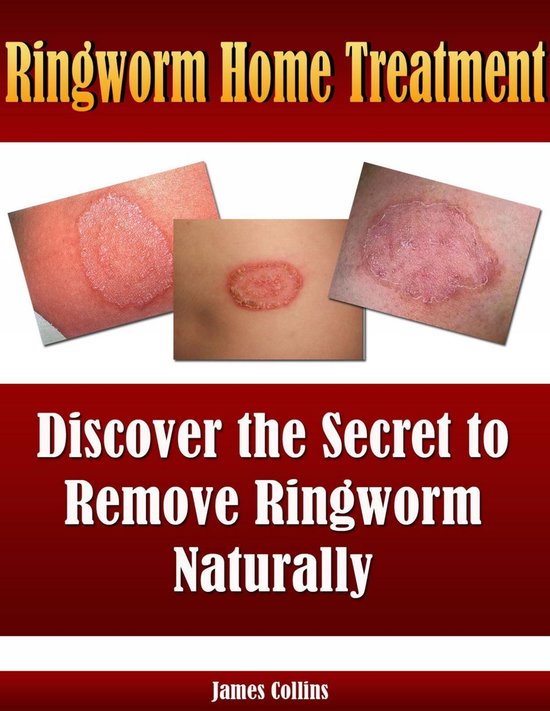 Ringworm Home Treatment - cover