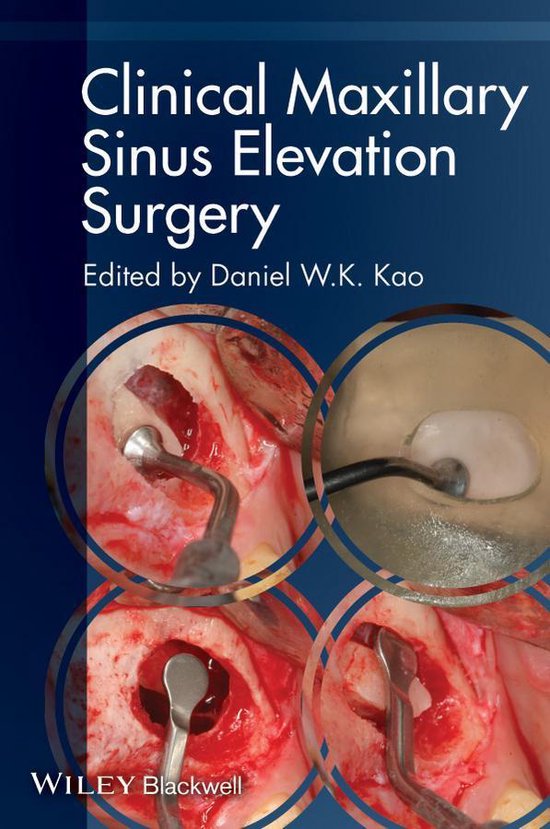 Clinical Maxillary Sinus Elevation Surgery - cover