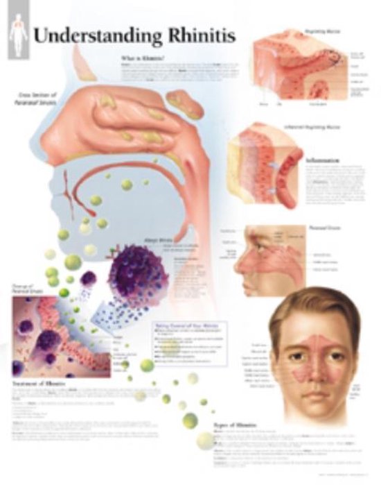 Foto: Understanding rhinitis laminated poster