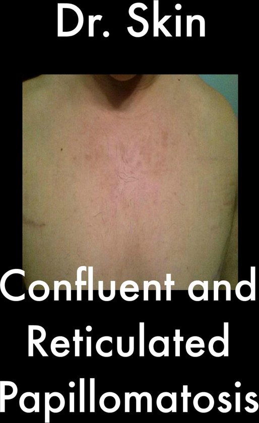 Bol Confluent And Reticulated Papillomatosis ebook Dr Skin 