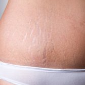 Lichaams Roller - Dermaroller Body + Vitamine C Serum 30 ml - Striae Behandelen - Littekens Behandelen - Lichaams Roller - Helpt Tegen Striae en Littekens - Maakt Collageen en Elastine in de Huid