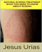 Natural Eczema Treatment