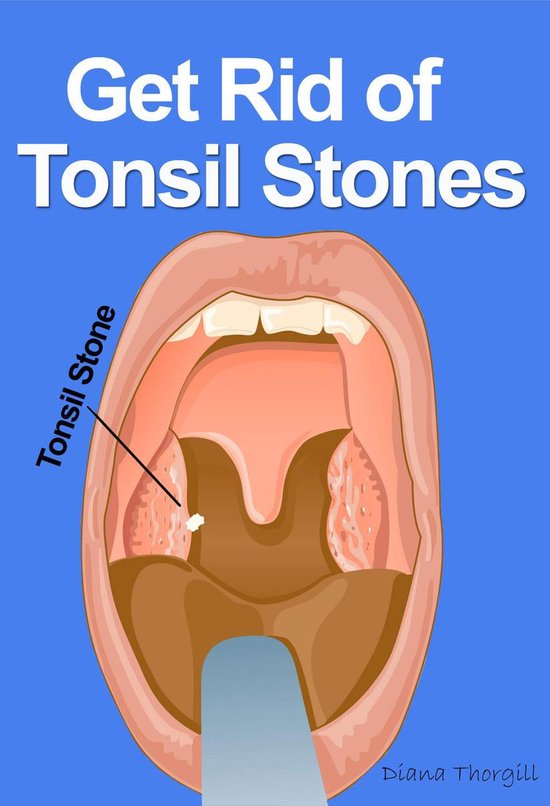 Get Rid of Tonsil Stones: Causes, Symptoms, Treatment, Removal and Other Re...