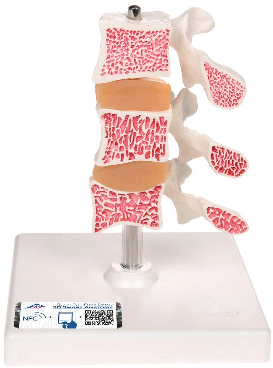 Osteoporose Model met 3 Lendenwervels op Statief en Gratis Anatomiesoftware