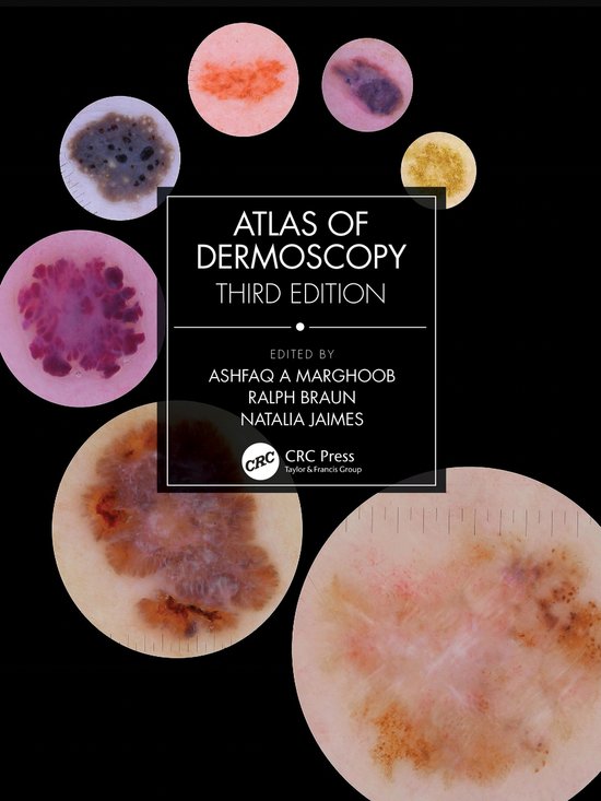 Atlas of Dermoscopy - cover