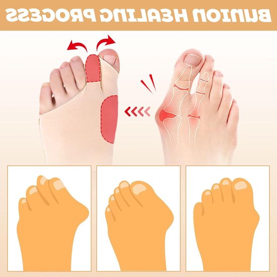 Professionele Orthopedische Correctors voor Hallux Valgus, Comfortabele Silicone Sokjes voor Pijnverlichting en Ondersteuning van de Voet — afbeelding 3