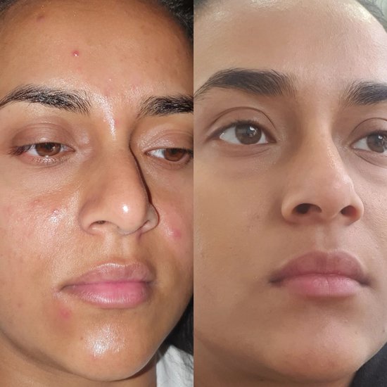 Voor en na foto van een vrouwengezicht met acne, verbeterd door puistjespatches.