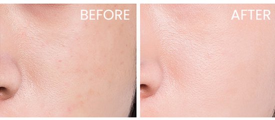 Gezicht voor en na gebruik van Nuxe Super Serum, met zichtbaar gladdere huid.