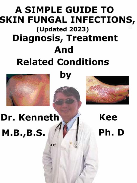 A Simple Guide to Skin Fungal Infections, (Updated 2023) Dia ... - cover