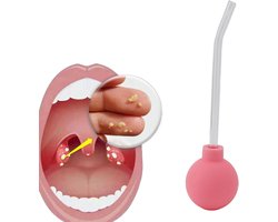 Tonsil stone remover - mondreiniger - voor behandeling van slechte adem - Vemera