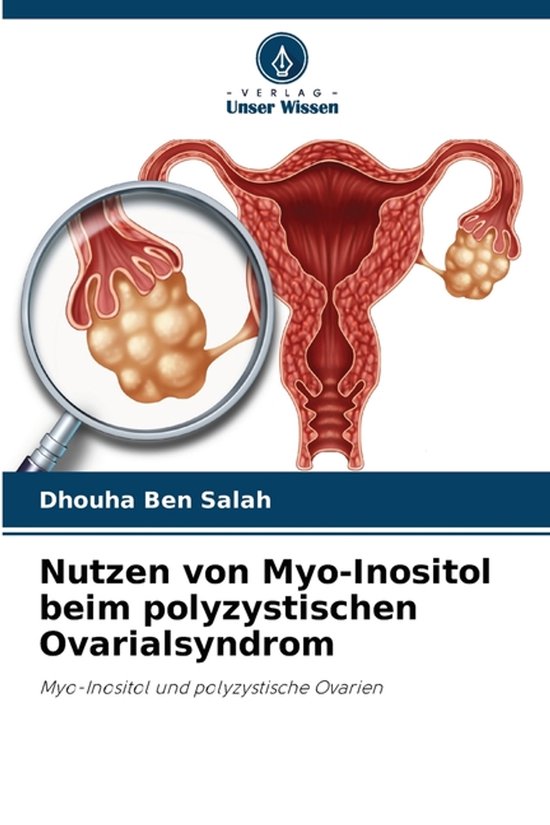 Nutzen von Myo-Inositol beim polyzystischen Ovarialsyndrom