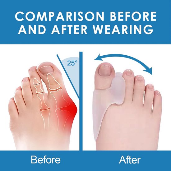 Hallux-Einlegesohlen für Stabilisierung im Zehgelenk