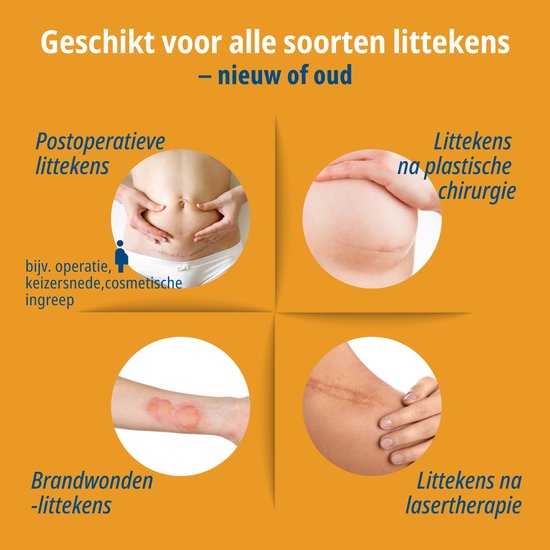 Overzicht van littekentypes behandeld door de siliconen pleister.