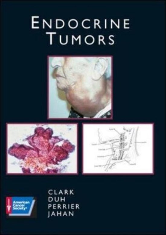 Endocrine Tumors