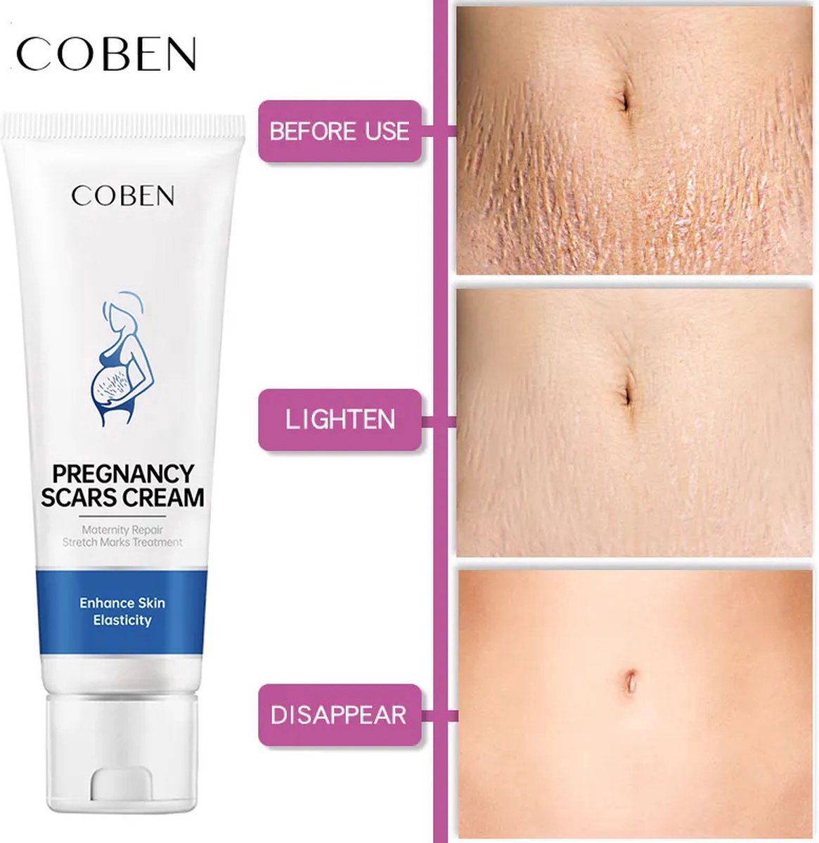 coben- Crème voor het verwijderen van littekens - verwijderd zwangerschap littekens - 40g - Vermindert en vervaagt oude of nieuwe littekens
