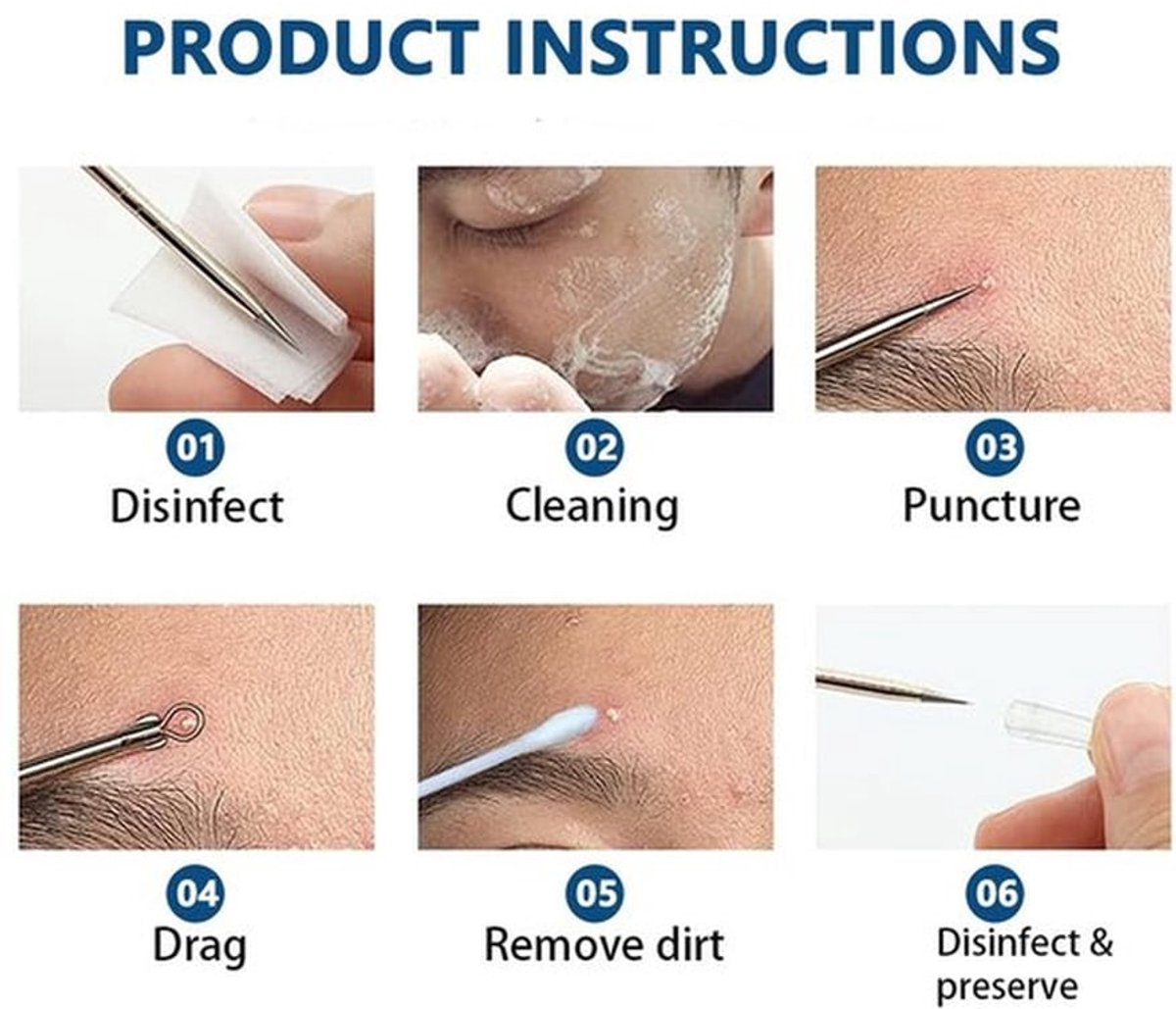 Comedonextractor 4 Stuks - Roestvrij Stalen Acne Naalden - Mee-eterverwijderaar - Pimple Popper Tool - Antislip Handvat - Eenvoudige Reiniging - Puistjesverwijderaar