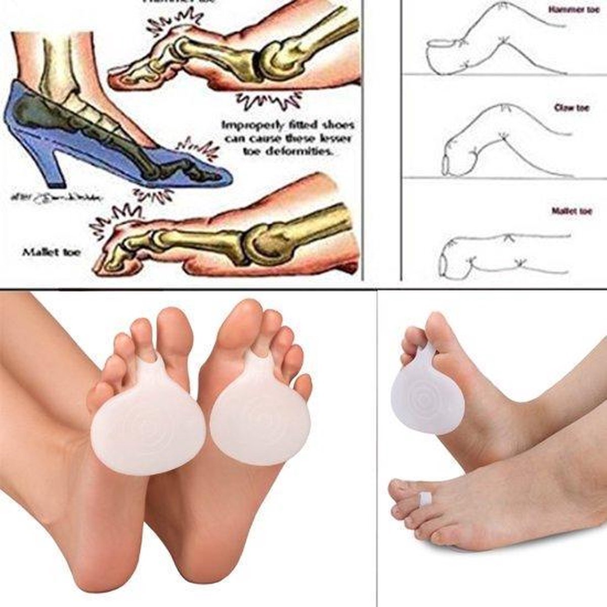 Coussinets de gel médical en silicone à l'avant-pied pour talons hauts - 2  pièces