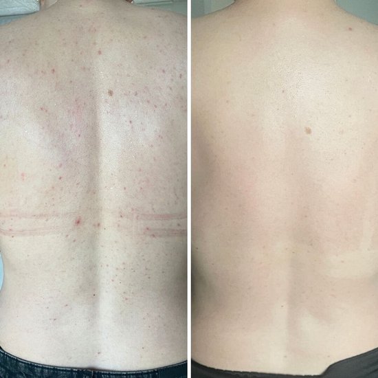 Salicylzuur spray tegen puistjes en verstopte poriën — Salicylzuur spray tegen puistjes en onzuiverheden. Met salicylzuur en glycolzuur voor diepe reiniging en gladde huid.