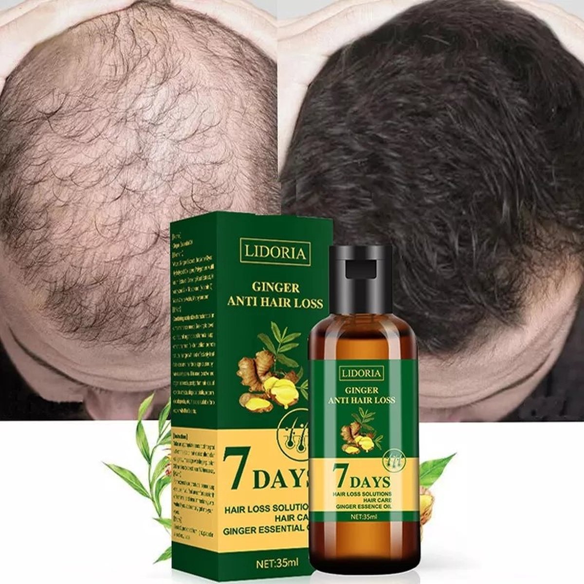 Repousse des cheveux 7 jours, huile essentielle de gingembre Germinal  croissance des cheveux traitement de perte de cheveux soin des cheveux  sérum de croissance des cheveux