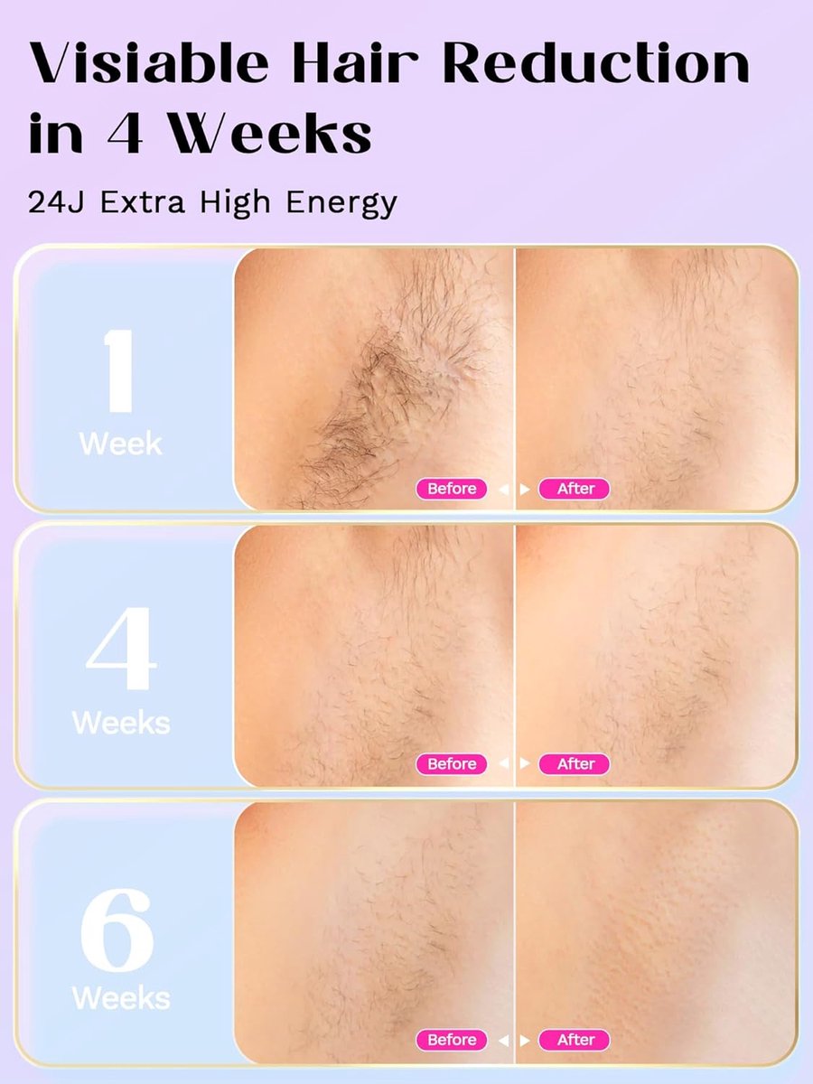Laser Hair Removal - Laserontharing - Met Ijskoelsysteem Hoge Energie 9 - Energieniveaus - IPL-Apparaten Ontharing Voor Vrouwen En Mannen - Lichaam, Gezicht, Oksels, Benen - (Roze) thumbnail 5