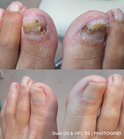 Voor-en-na foto's van een behandeling van teennagels.
