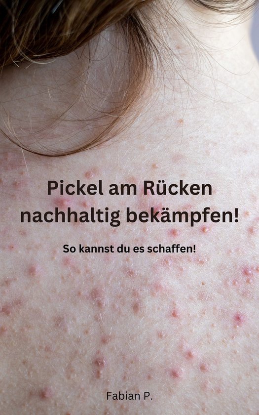 Pickel am Rücken nachhaltig bekämpfen! (ebook), Fabian P. 9783756842483 Boeken