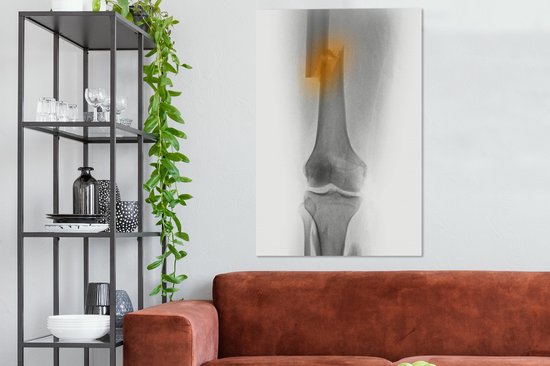Radiographie de la cuisse d'un homme de 30 ans impliqué dans un accident de moto 80x120 cm - Tirage photo sur toile (Décoration murale salon / chambre)