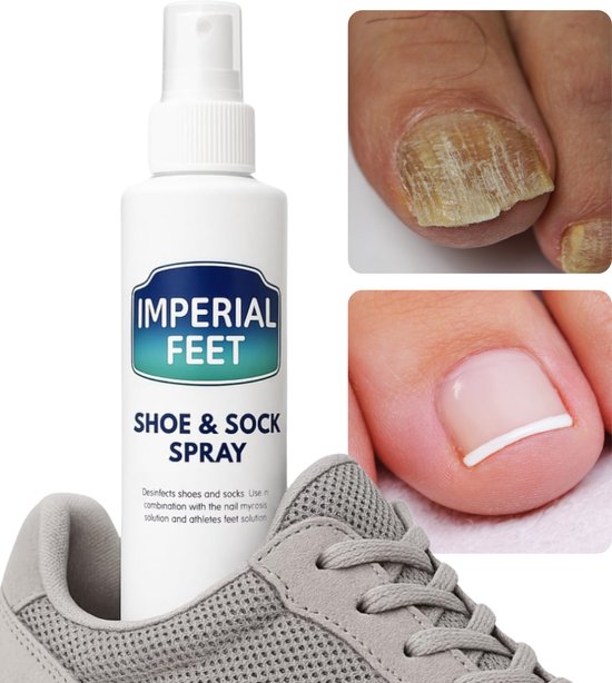 Schoen Sok Spray Teennagelschimmel Behandeling - Anti schimmelnagel voor Ernstige Nagelschimmel Spray - Verzorging van Kalknagels - Kalknagel Behandeling - kalknagels Behandelen - XL 150ML - Nederlands - Anti Kalknagel Behandeling Spray