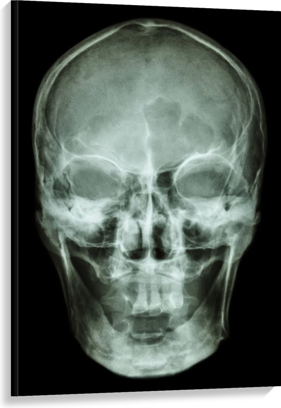 Canvas - Röntgenfoto van Mensenschedel - 80x120 cm Foto op Canvas Schilderij (Wanddecoratie op Canvas)