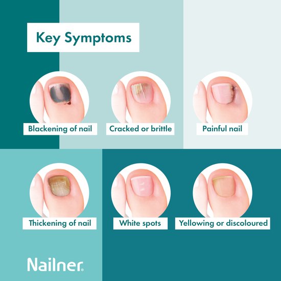Nailner Kalknagelkwastje 5 ml - Kalknagelbehandeling voor Kalknagel en Schimmelnagel, Medische hulpmiddelen om Kalknagels te behandelen en voorkomen, effectief binnen 4 weken, eenvoudig aan te brengen zonder te vijlen, voor dagelijks gebruik