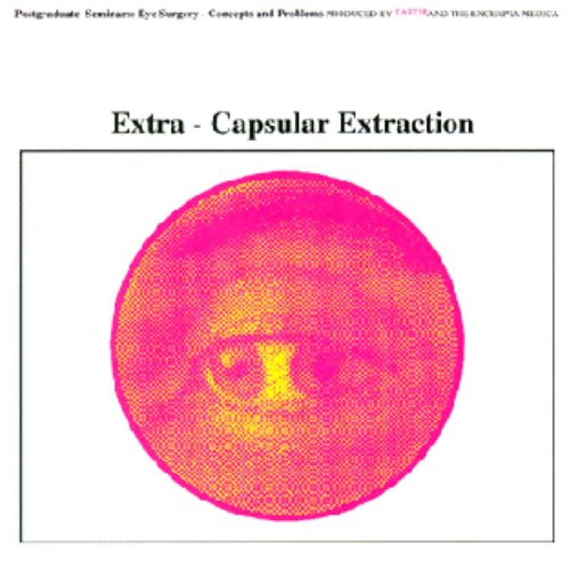Earth - Extra-Capsular Extraction (LP)