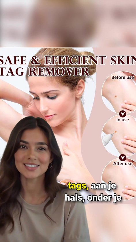 Laser Plasma Pen voor Steelwratjes Verwijderen – Professionele Wrattenverwijderaar & Skin Tags Verwijderen – Inclusief Opzetstukken – Voor Thuisgebruik – Veilig, Precisiegericht en Effectief – Geschikt voor Vrouwen & Mannen