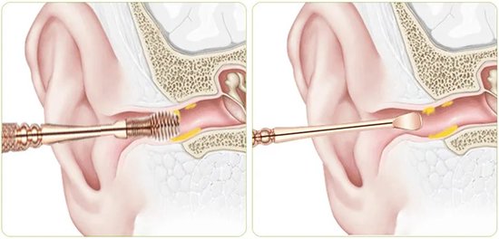 Nettoyeur D'oreille Avec 16 Embouts - Enlève Le Cérumen Facilement Et En Douceur
